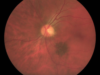 Pictor Plus™ Fundus Camera