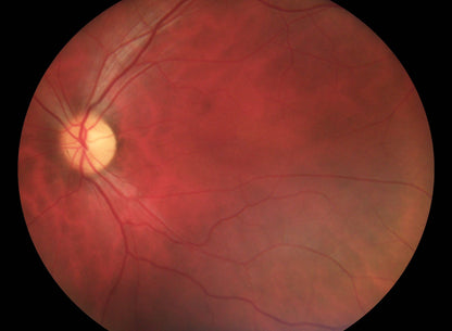 Pictor Prestige™ Portable Fundus Camera with Optional Anterior Module